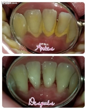 Limpieza dental /profilaxis